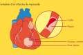 Santé / Cholestérol et infarctus : faut-il avoir peur ?